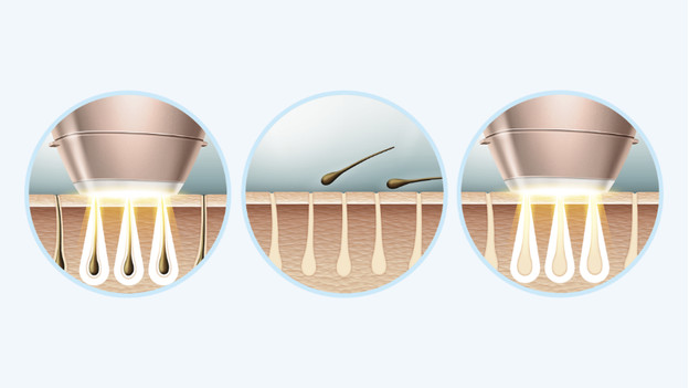 What's IPL hair removal